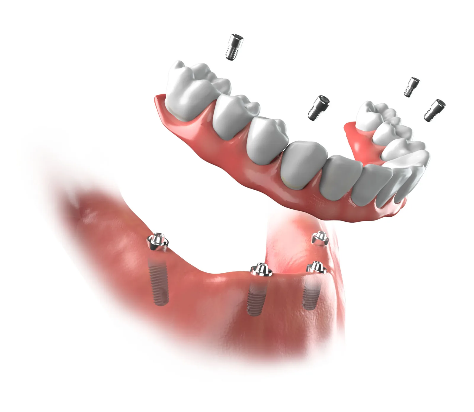 Illustration of a lower full-arch bridge lifted above four implants placed in the jaw