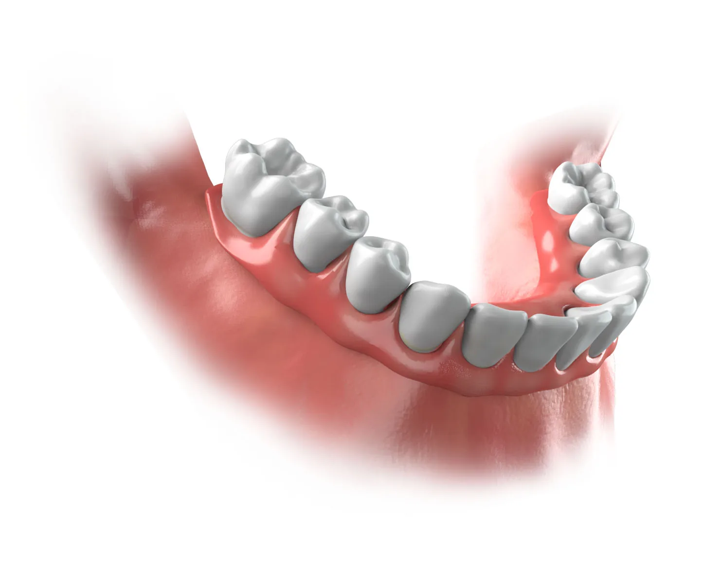 Illustration of a fixed full-arch bridge seated on the lower jaw