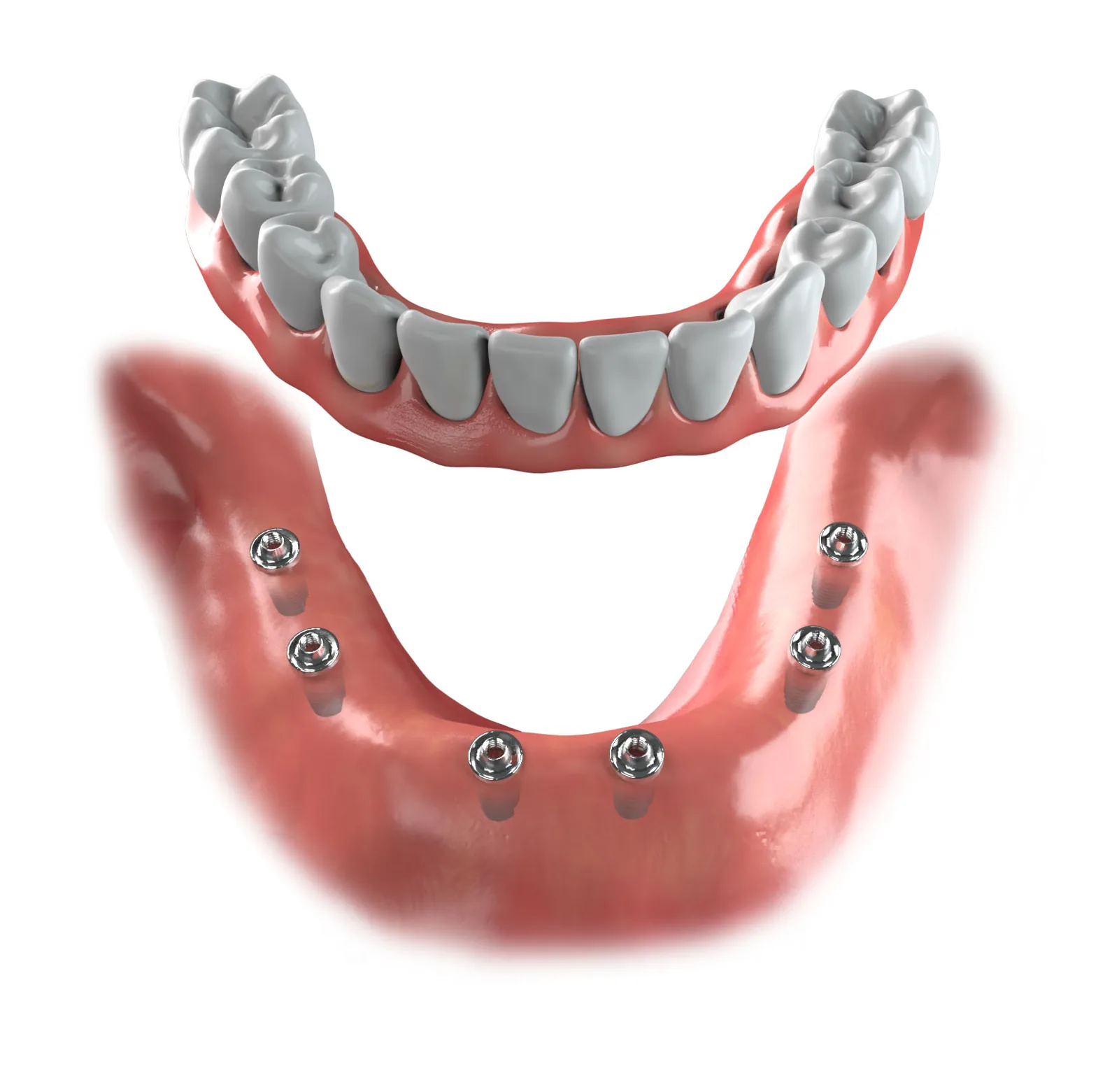 Illustration of a lower full-arch bridge above six implants