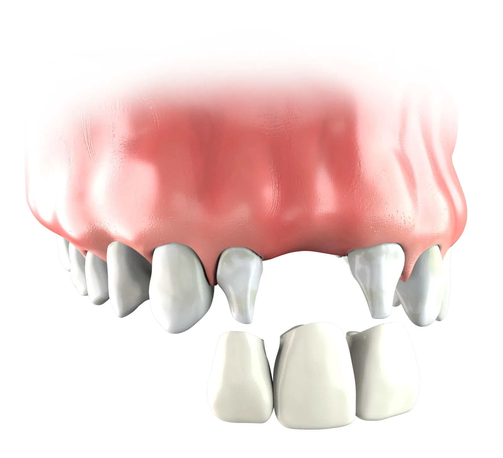 Illustration of a traditional three-unit bridge replacing one upper tooth