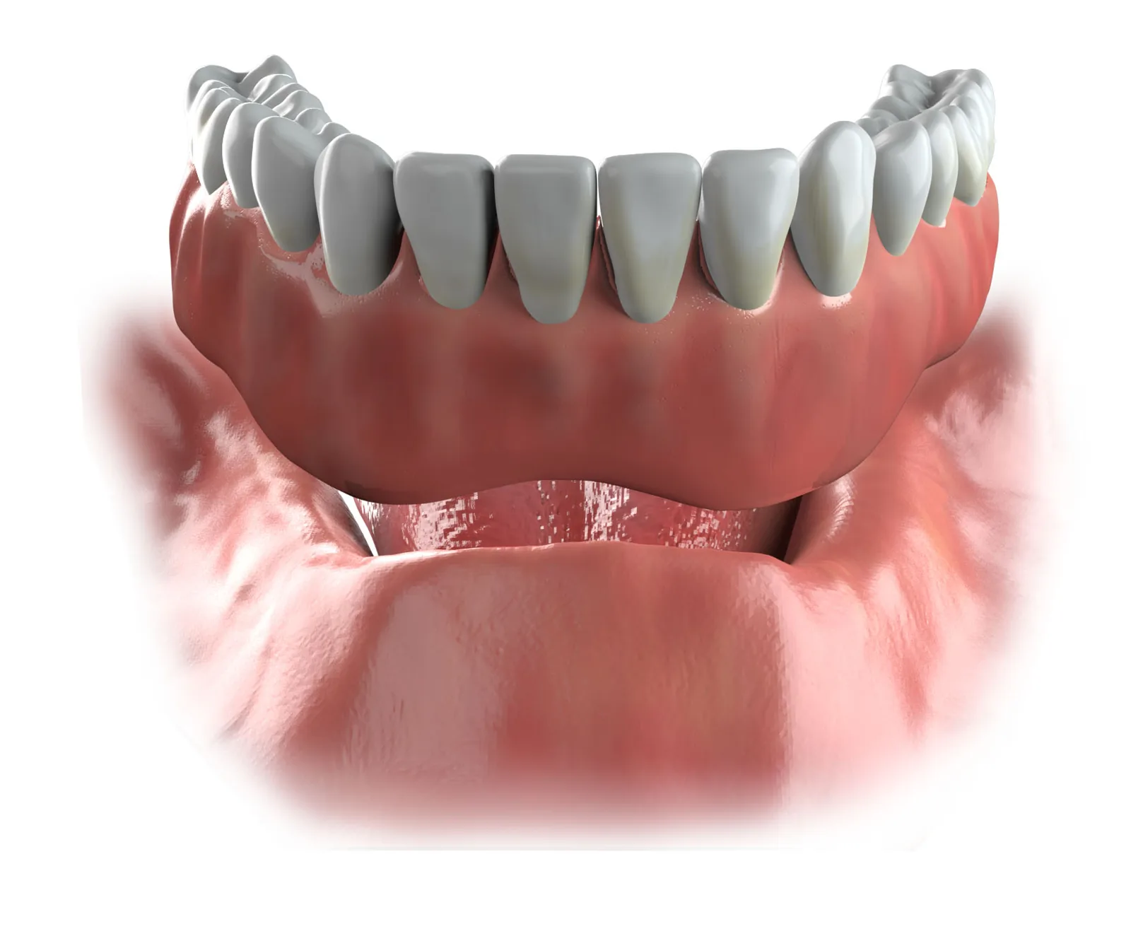 Illustration of a conventional lower denture resting on the gums