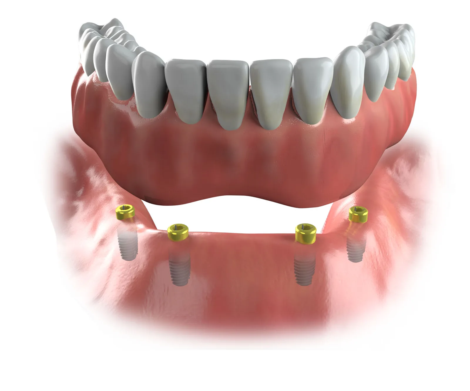 Illustration of a lower denture that snaps onto attachments on implants