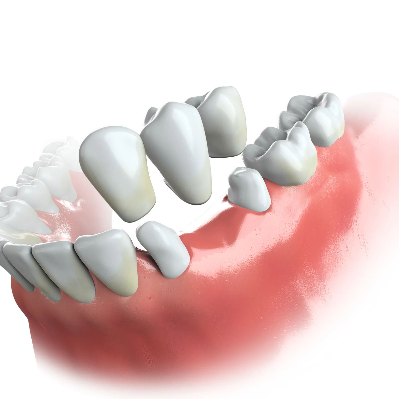 Illustration of a removable partial denture replacing lower back teeth