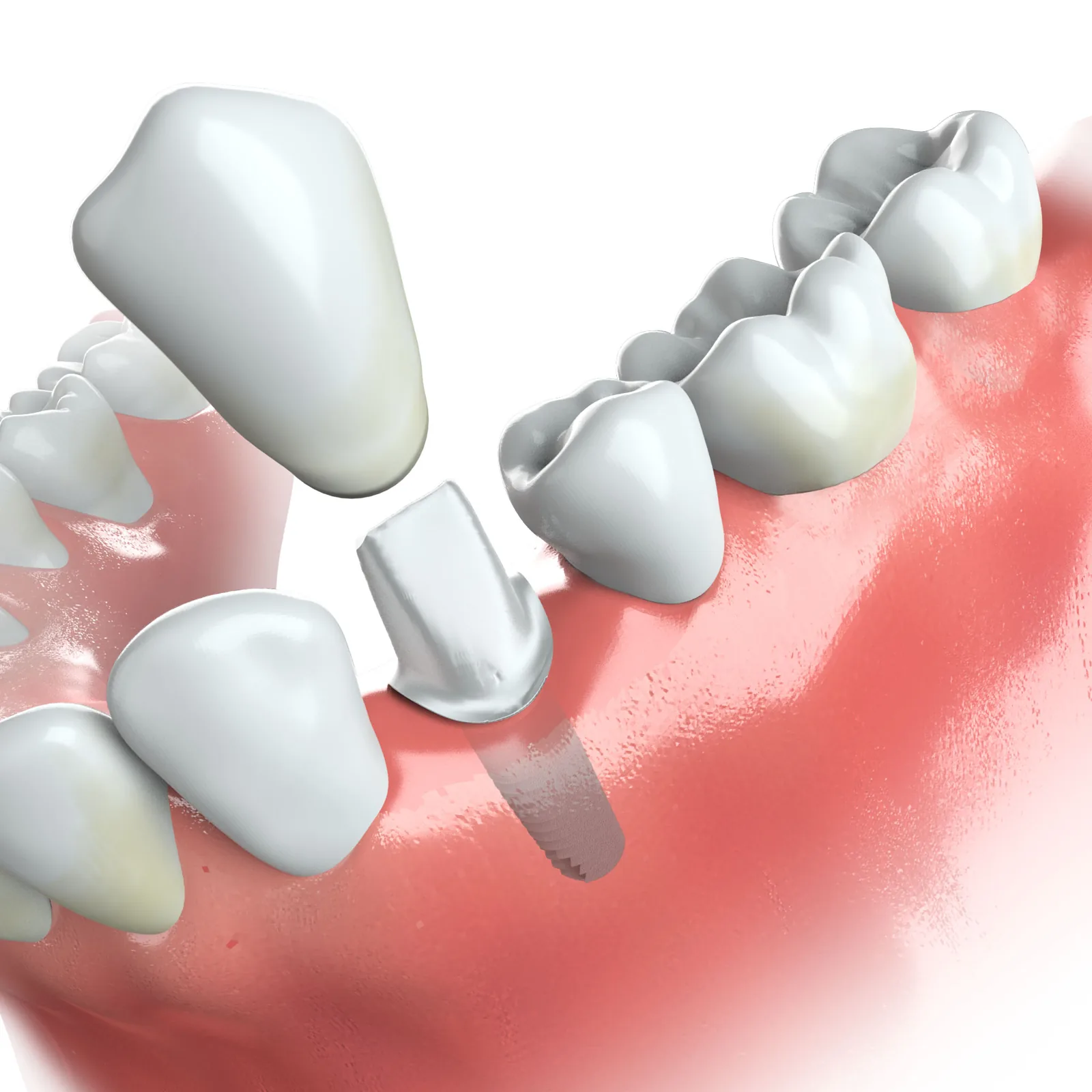 Illustration of a single dental implant in the lower jaw with the abutment and crown shown above it