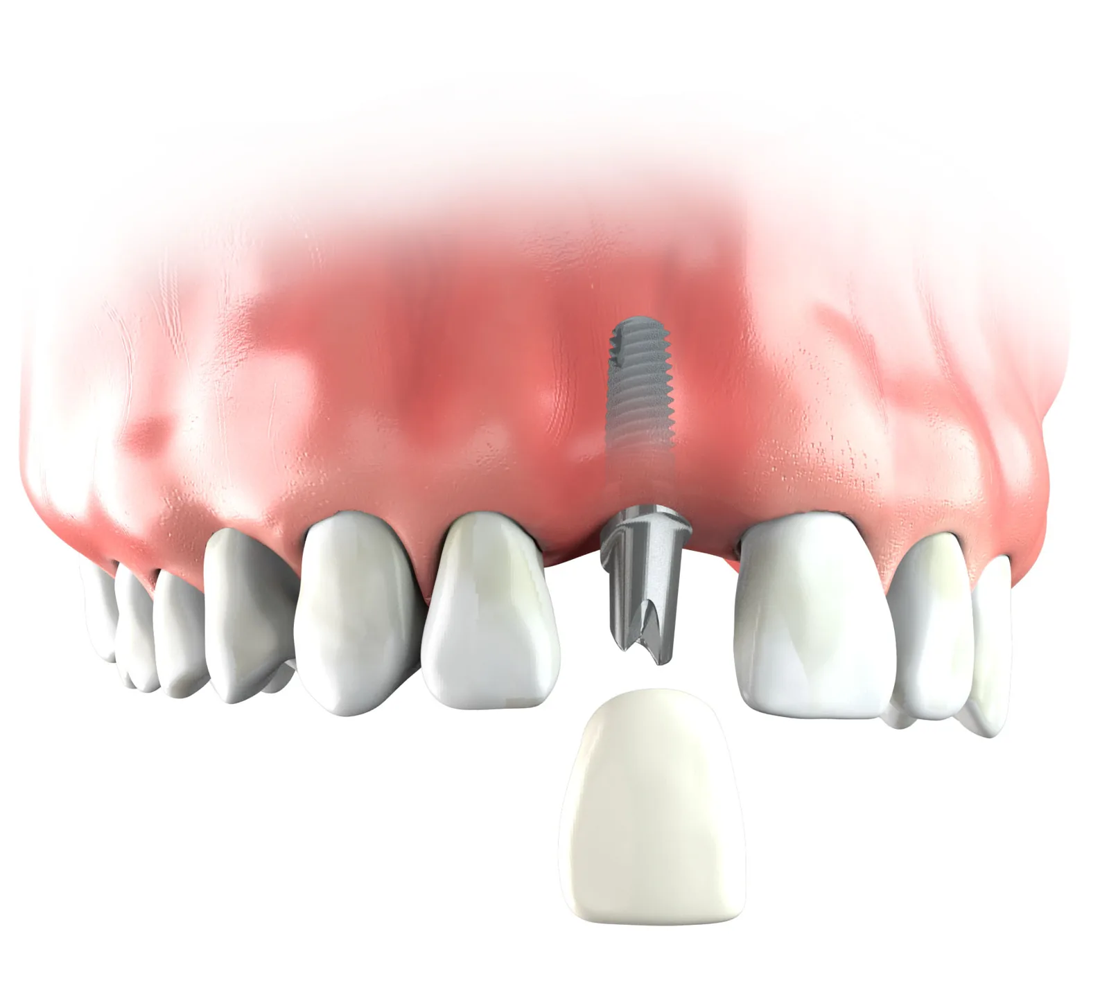 Illustration of a single implant replacing an upper front tooth, with the crown shown below it